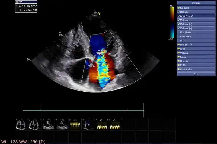 echocardiogram