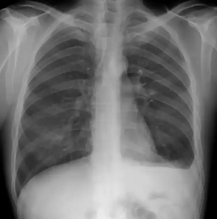Chest X-Rays with Artificial Intelligence Catch More Lung Cancer