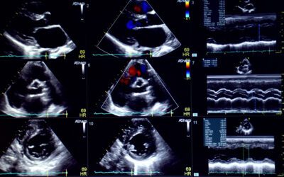 Let Hollywood Diagnosticss Handle Your EKG & Echocardiogram Testing