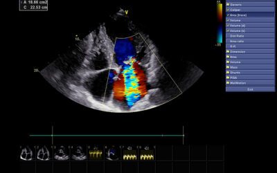 Important Facts About Echocardiograms