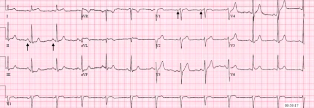 Important Facts About EKGs
