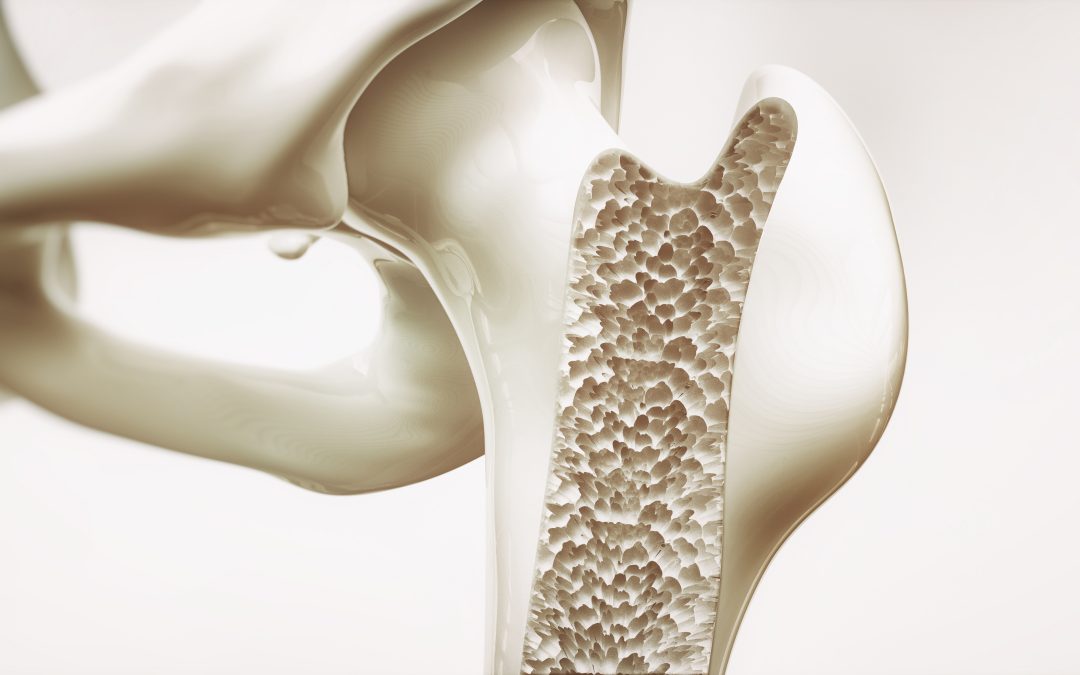 Getting Your Bone Density Test at Hollywood Diagnostics