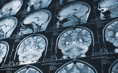 A Revolutionary Brain Scanning Helmet?