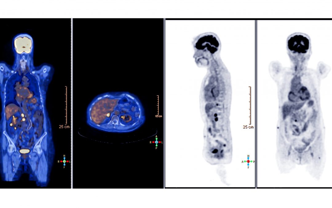 What Should You Expect When Getting a PET Scan?