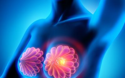 Monitoring for Breast Cancer