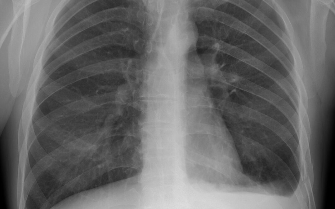 Chest X-Rays with Artificial Intelligence Catch More Lung Cancer