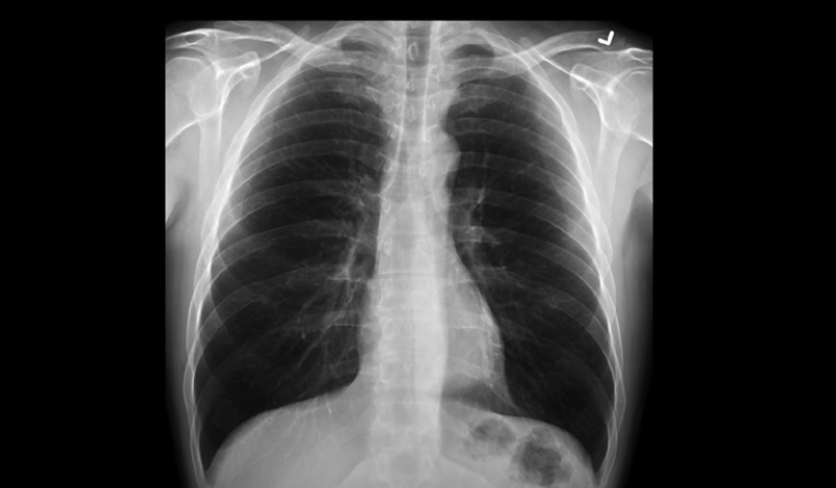 Chest X-Rays with Artificial Intelligence Catch More Lung Cancer