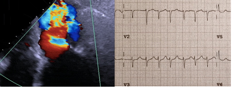 Echocardiograms vs. EKGs: What Are the Differences