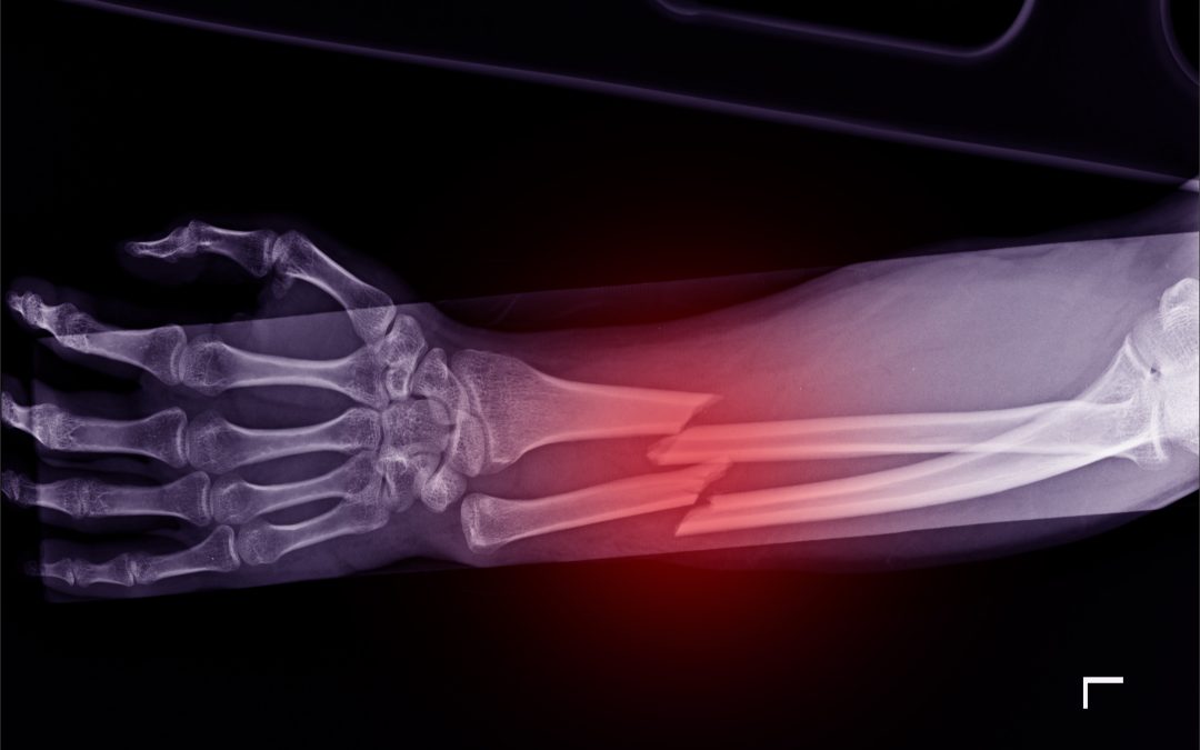 Assessing the Damage of a Broken Bone