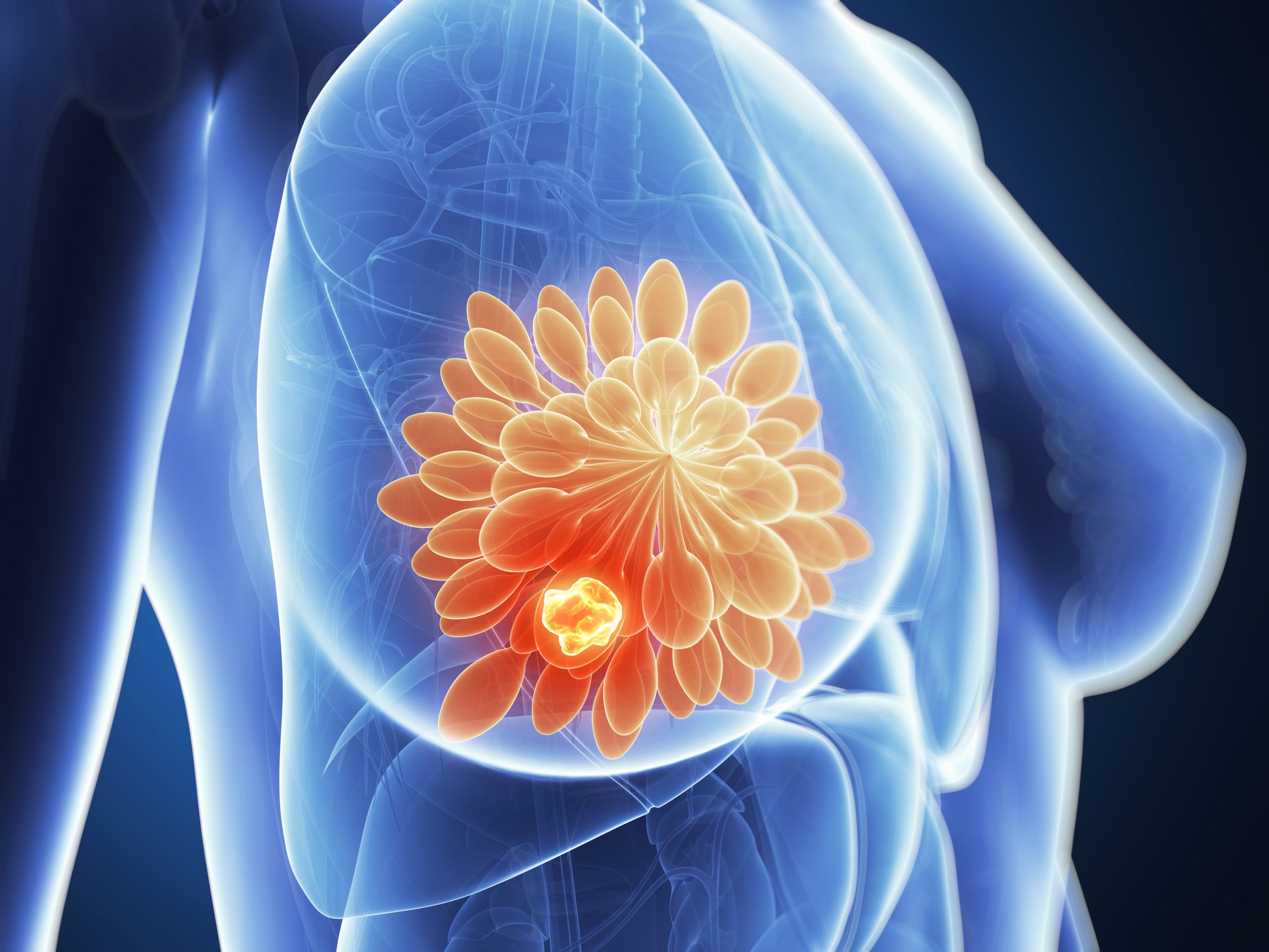 Learning How to Recognize Signs of Breast Cancer Hollywood Diagnostics