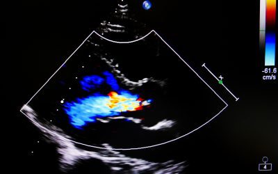Echocardiogram Versus Ultrasound