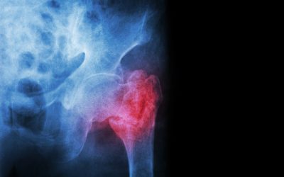 How Long Does a Bone Fracture Take to Heal?