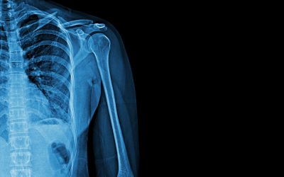 Why You Should Always Get X-rays After a Bone Injury