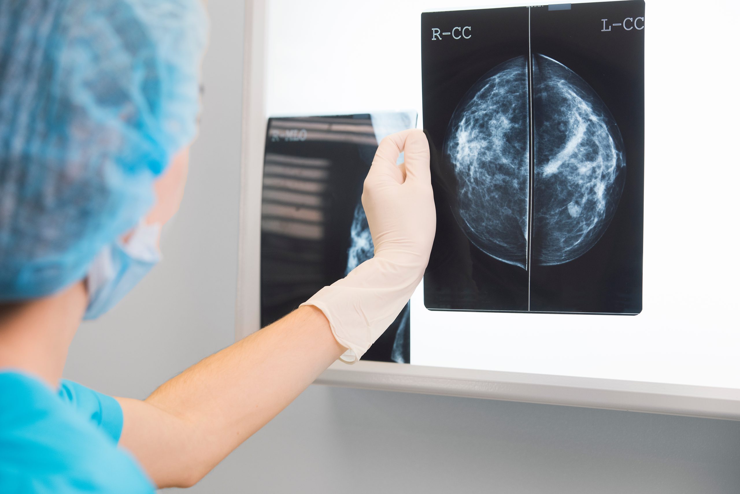 3D Tomosynthesis Mammography, Hollywood Diagnostics